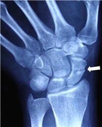 Scaphoid Fracture XR